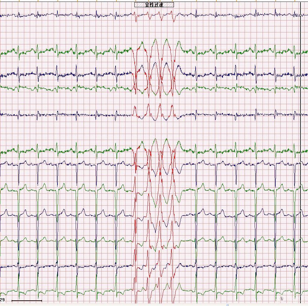 是短阵室速还是蝉联现象啊 心电图脑电图专业讨论版 爱爱医医学