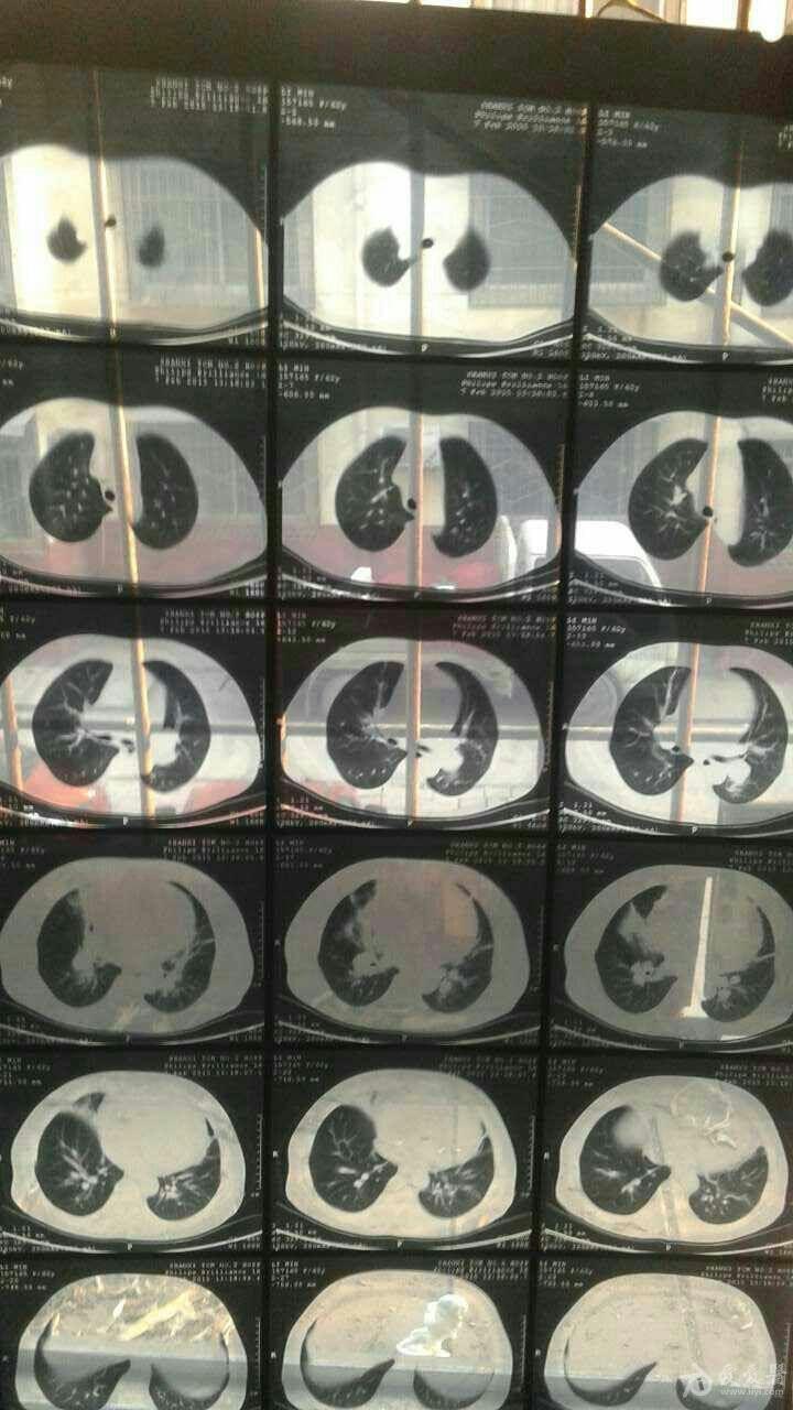 求教!是否可断定右肺门问题和进行肿瘤检查