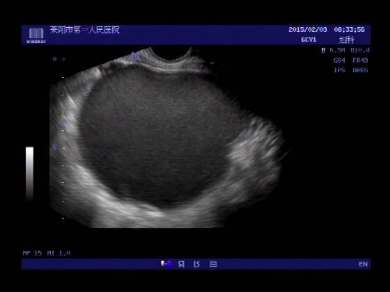 超声入门贴423----巧克力囊肿(经腹部图和经阴道图比对,阴超的魅力)
