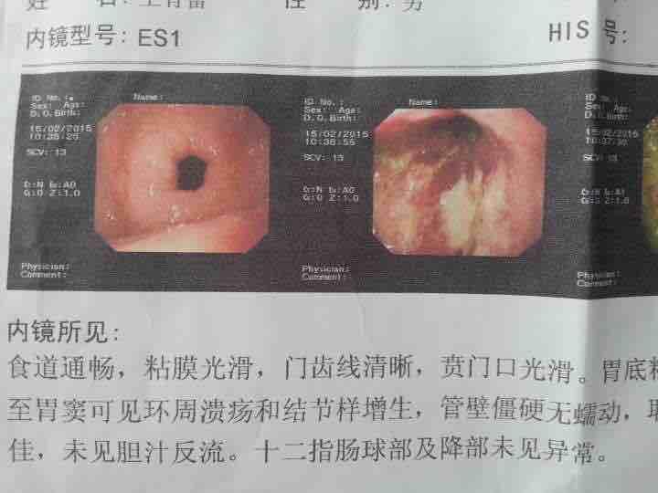 能确诊胃癌晚期?