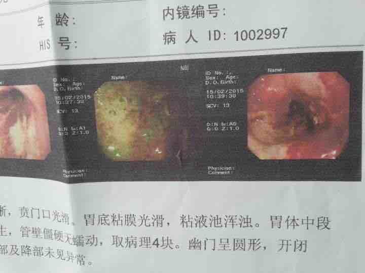能确诊胃癌晚期?