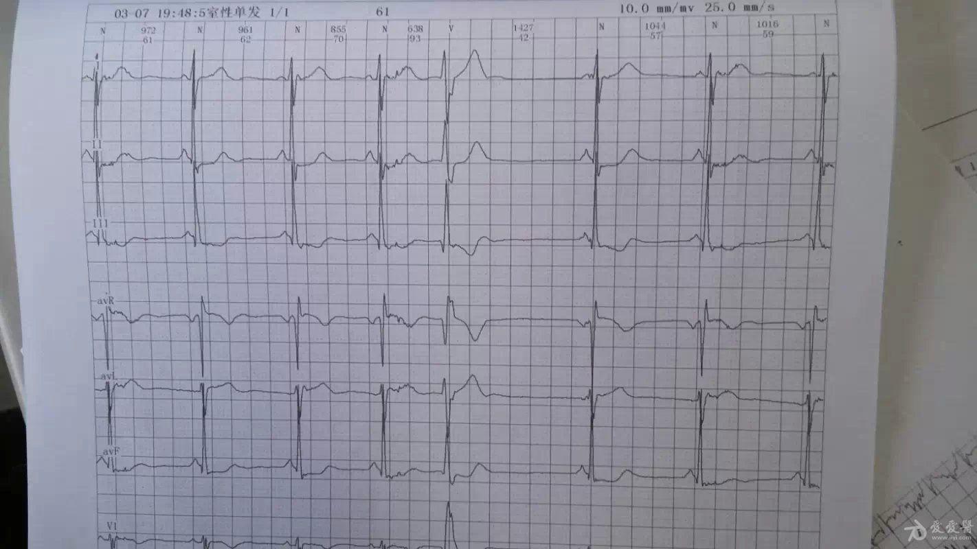 交界性逸搏或房性逸捕 心电图脑电图专业讨论