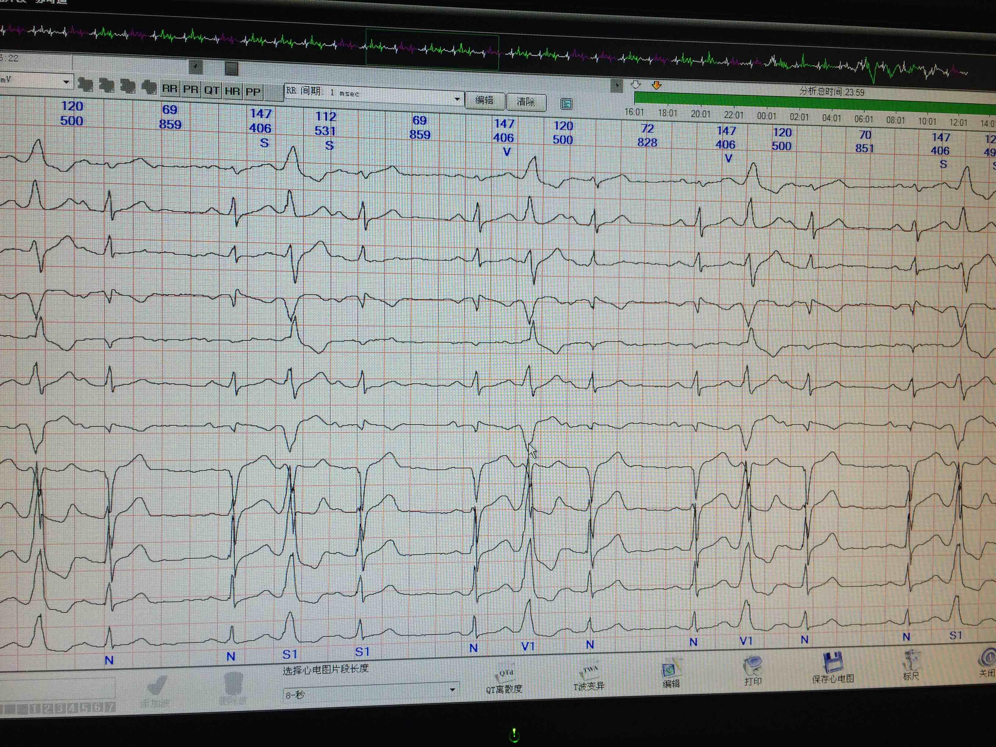 21:22:39请教老师们,这个患者因心悸入院,holter提示以下图形:心搏