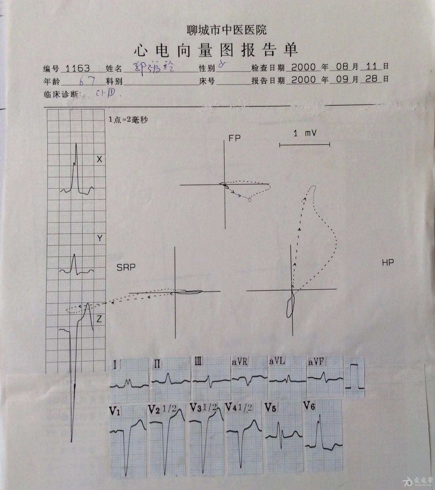 看心电图--熟悉向量图--图70-完左,左室肥大