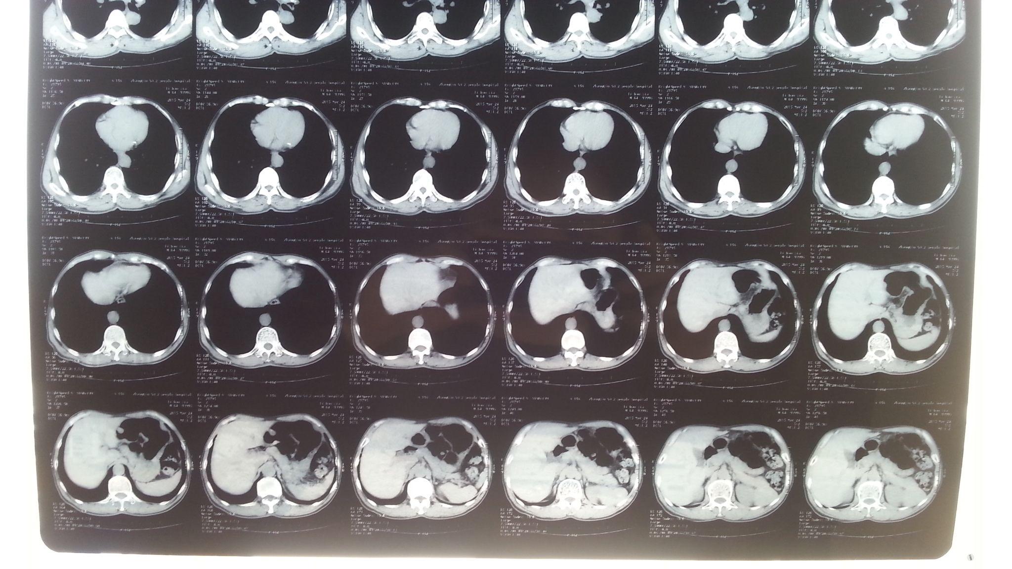 矽肺ct,求助