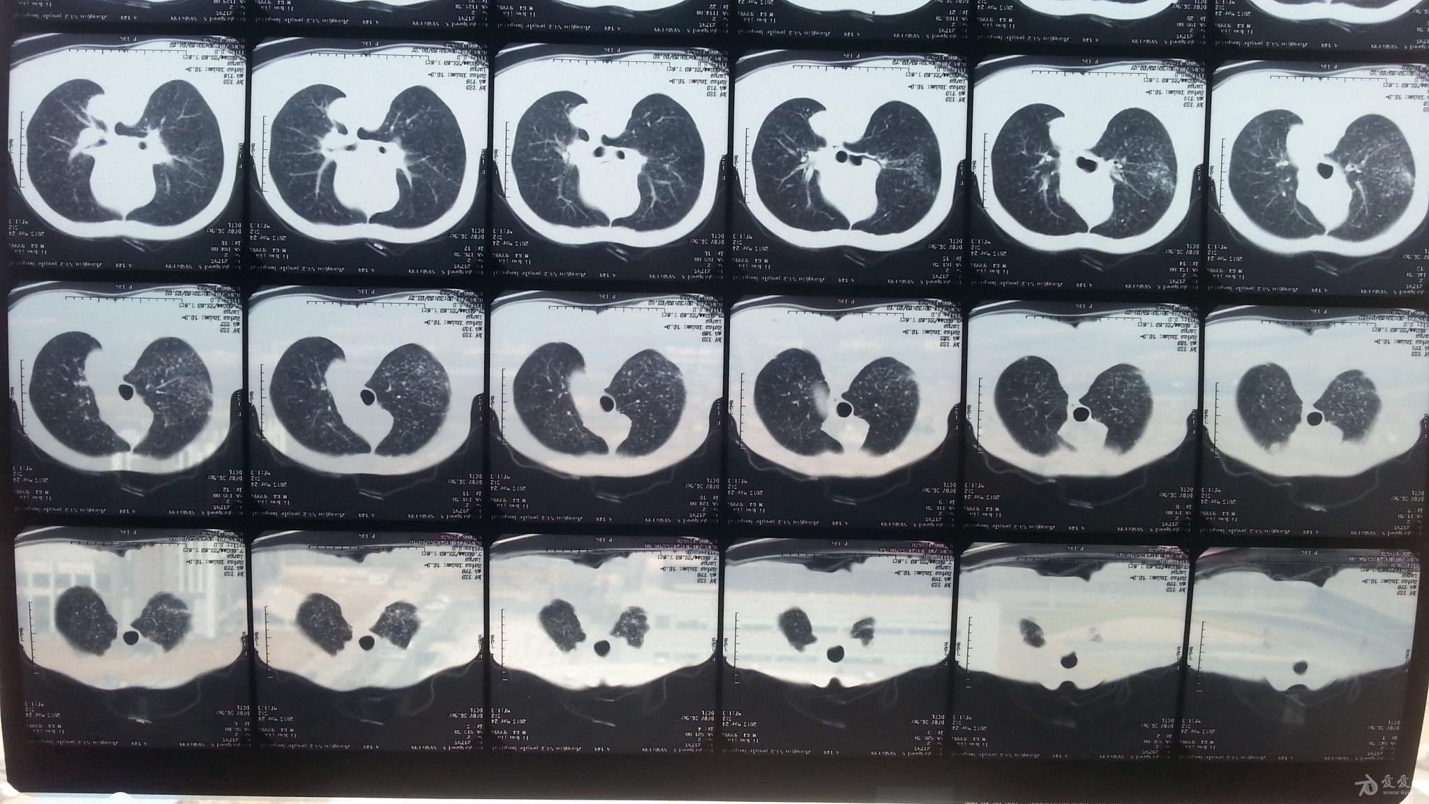 矽肺ct,求助