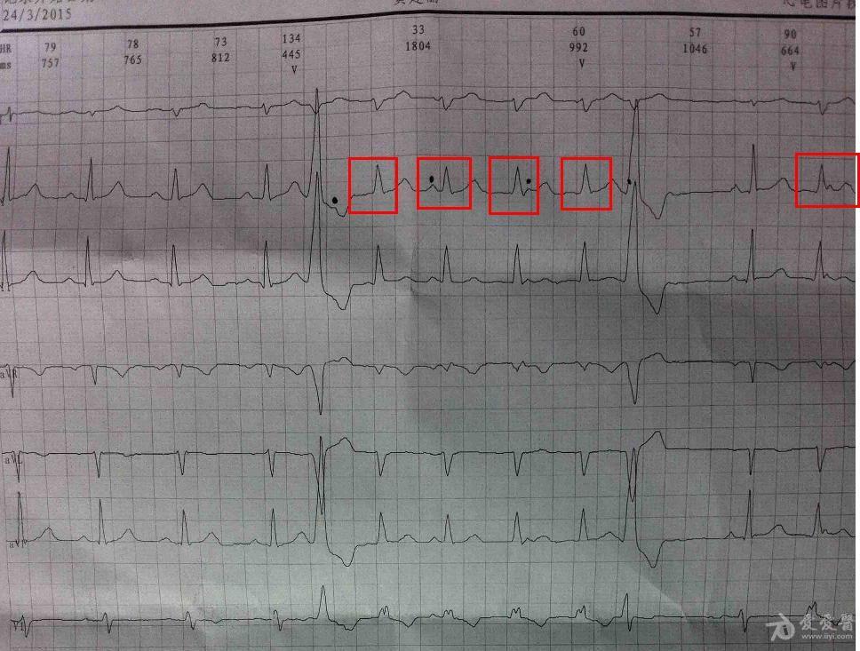 请老师帮忙 心电图脑电图专业讨论版 爱爱医医学论坛 爱爱医