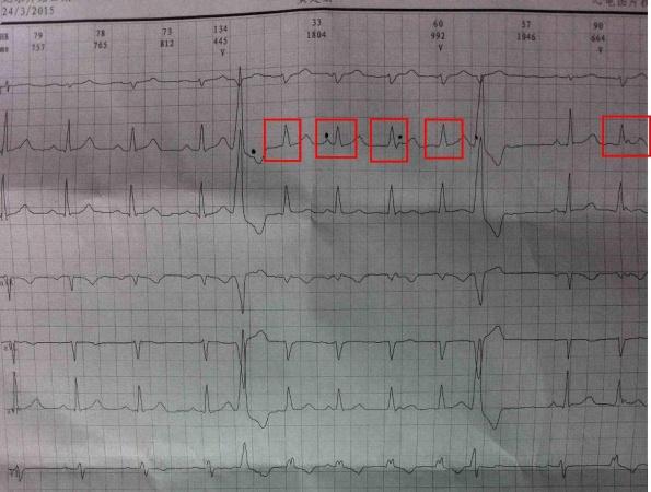 1,另外一个源的室性早搏——加速性室逸伴房室分离;2,加速性交界性