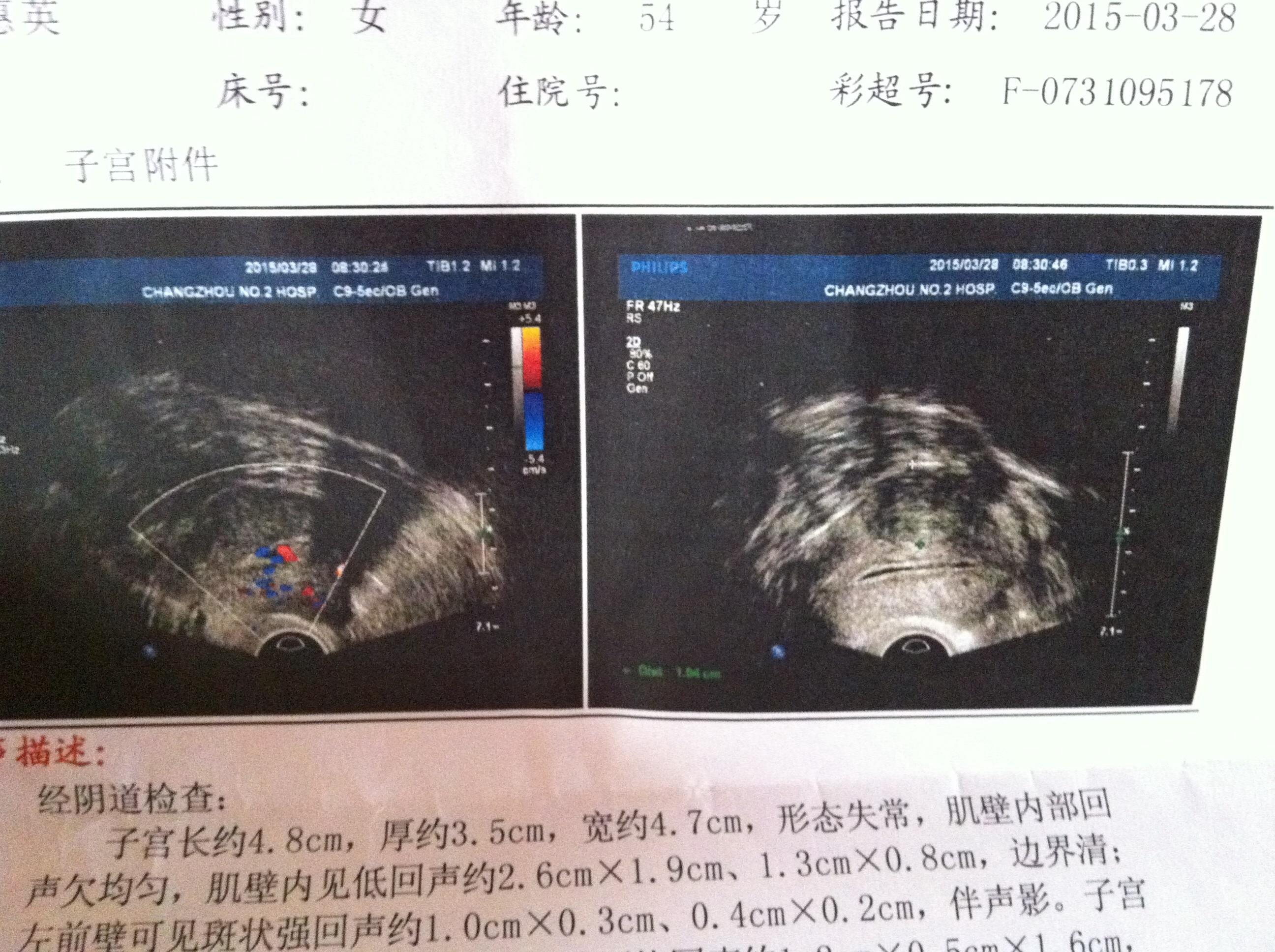 宫腔积液伴不均团块,考虑什么?