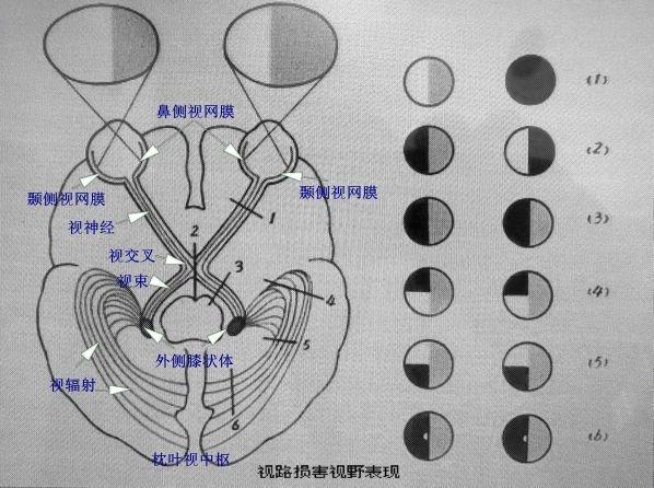 颞侧偏盲,对侧同向性偏盲解释一下什么意思?