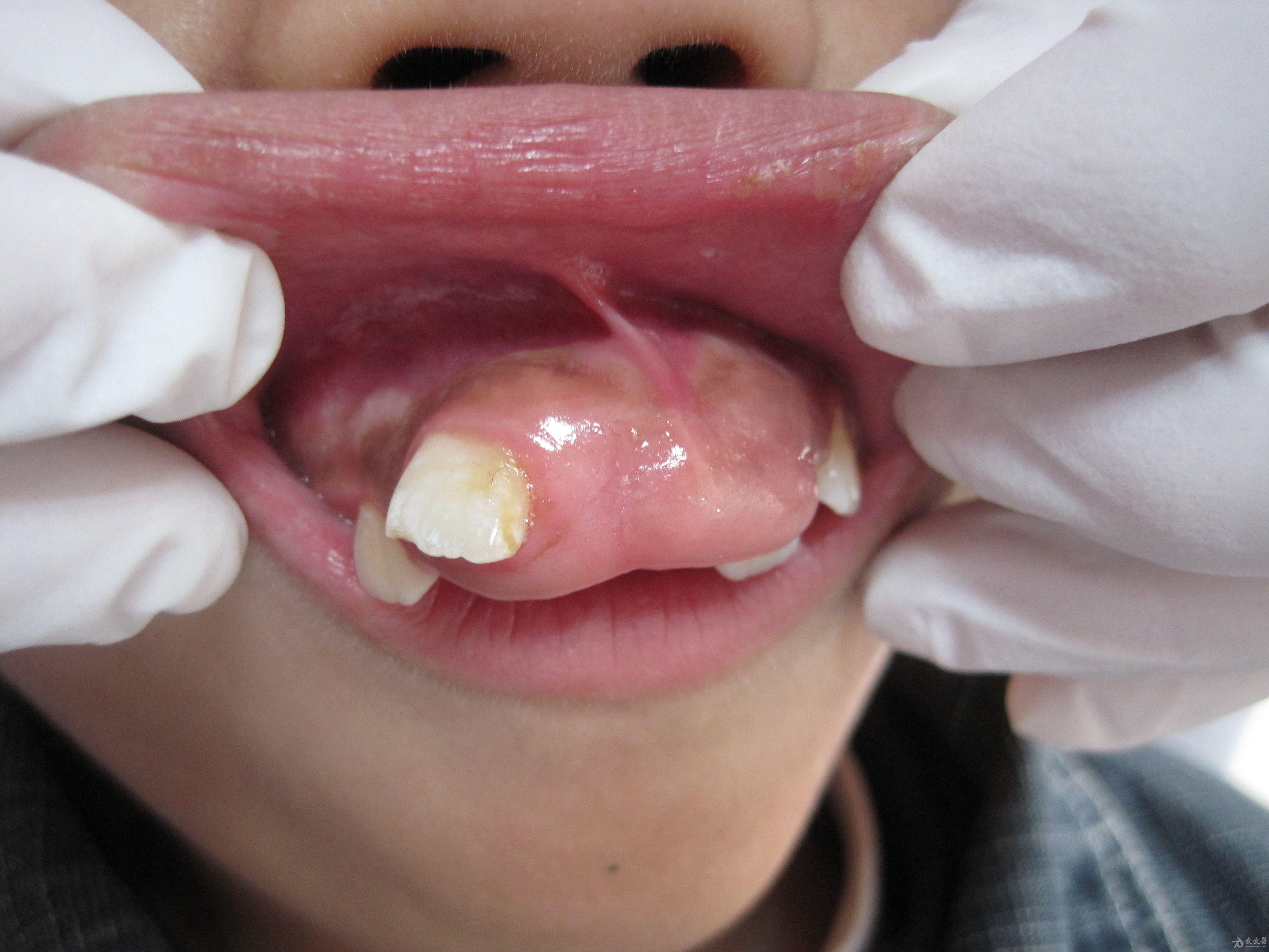 外伤致牙龈瘤