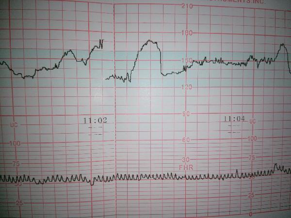 胎心监测图