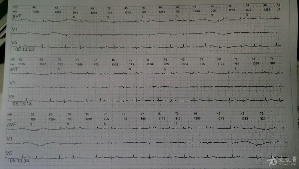 房颤心电图求解!谢谢各位老师进来看下.