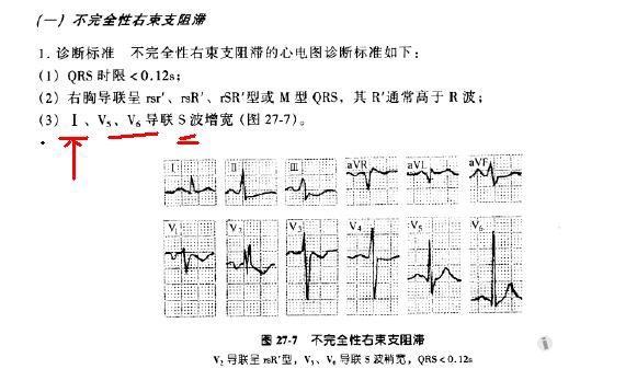 关于郭继鸿-心电图学:不完全性右束支阻滞 图例的一点疑问.