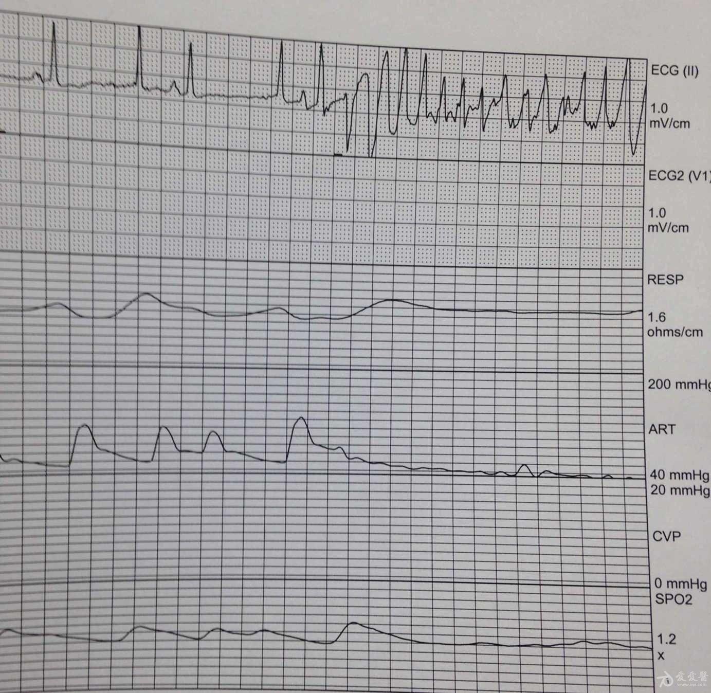 心电图系列之二危急值识别(下)