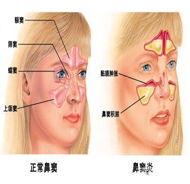 解剖基础3—鼻窦