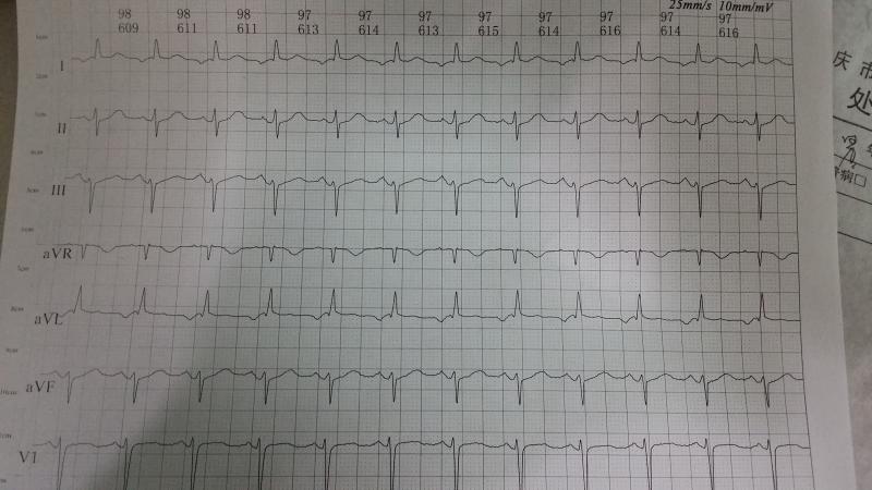 这是什么心律?p波下壁直立,l avl倒置.谢谢