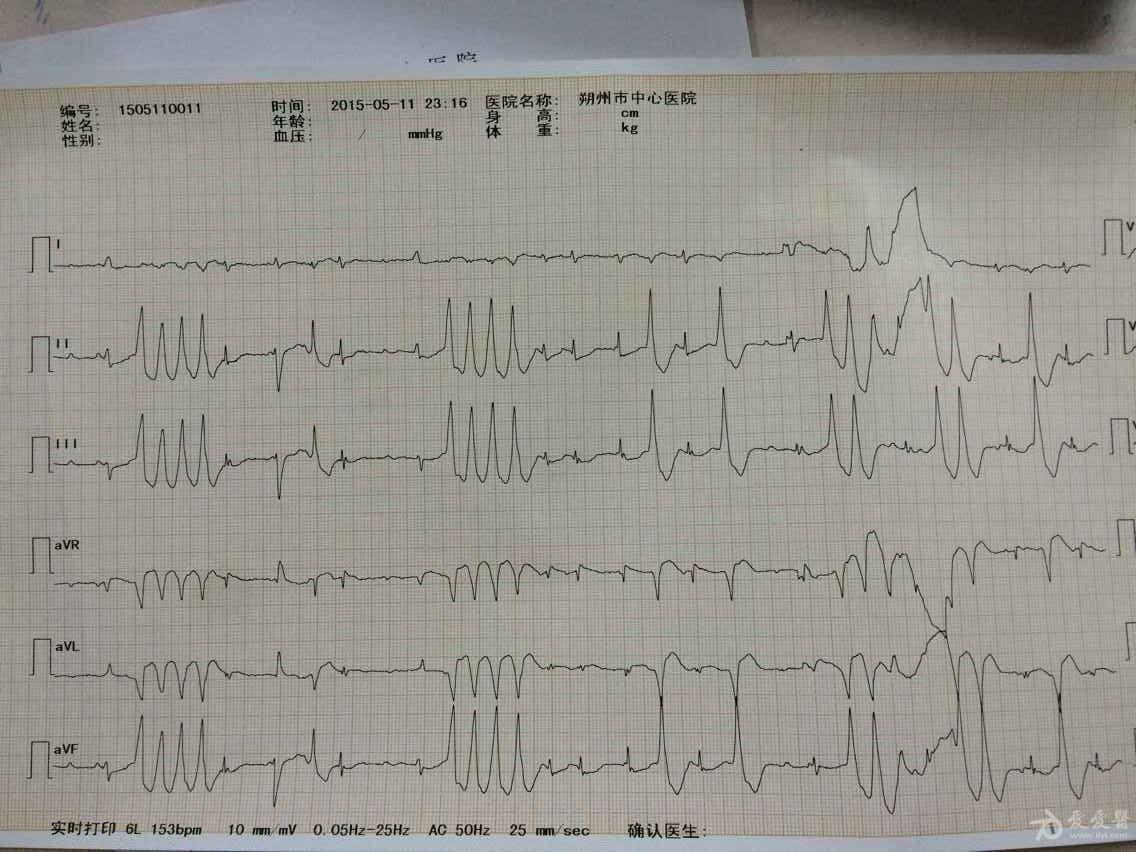 疑难心电图