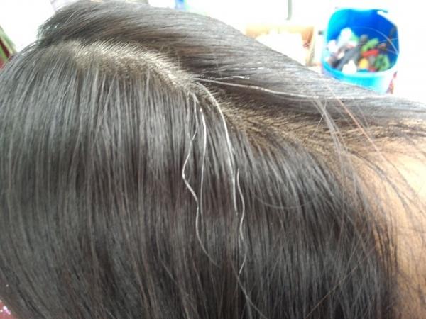 <em>后脑勺白头发</em> - 皮肤及性传播疾病讨论版 - 爱爱
