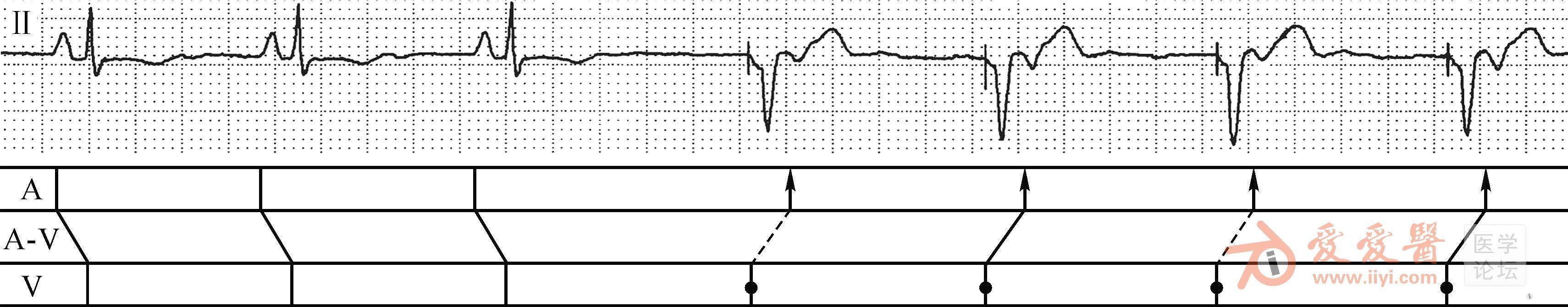 何方田老师起搏心电图讲座之五 解读心室起搏器(vvi,vvir)的心电图