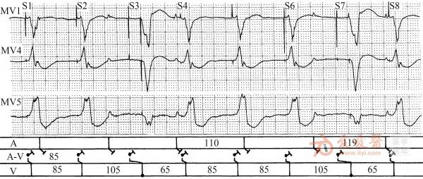 何方田老师起搏心电图讲座之九 根据起搏p′,qrs′波形判断起搏部位
