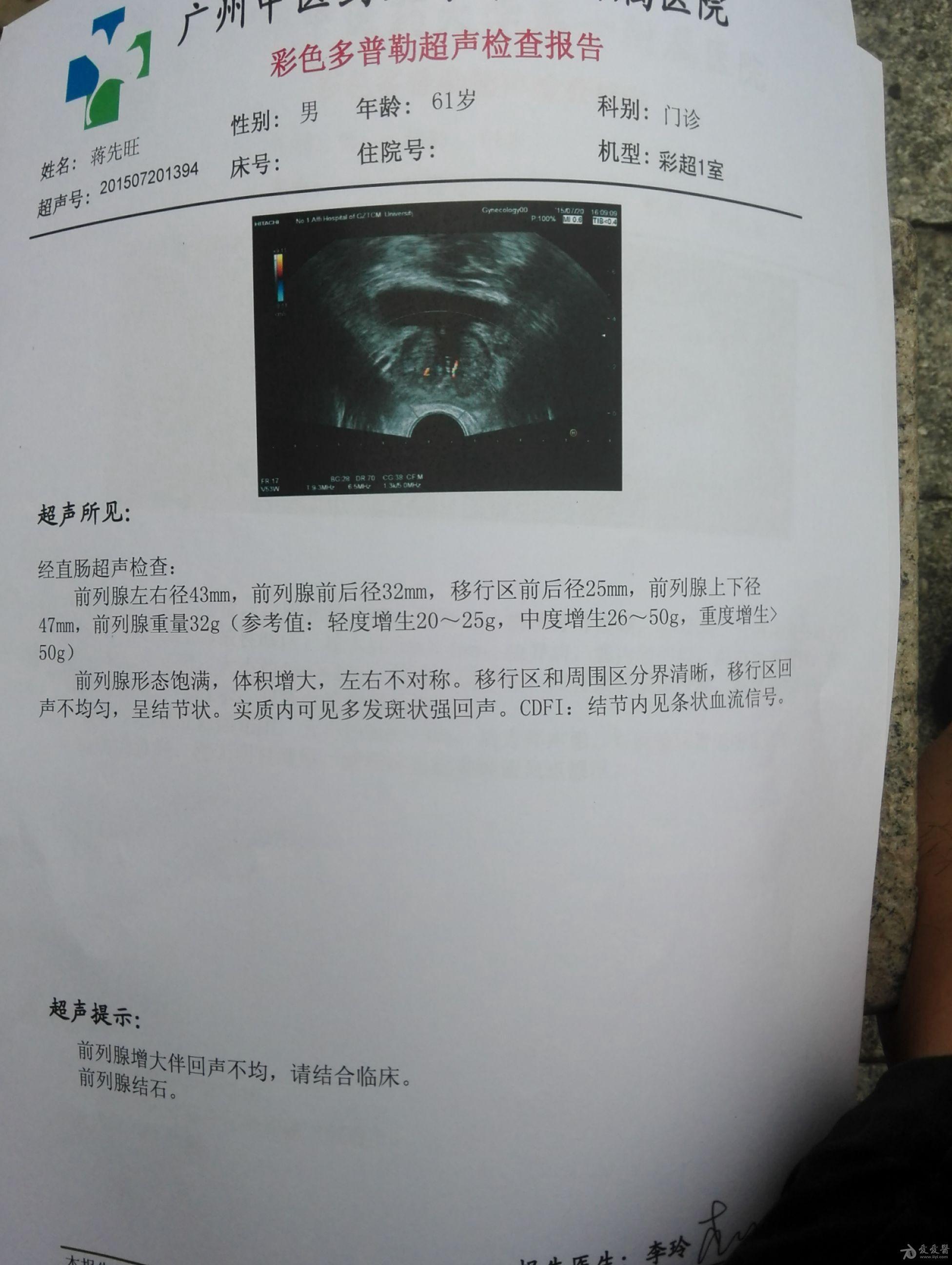 已排掉肾结石,而且是肾下盏结石5mm,肾下盏结石都是很难排的,但这个