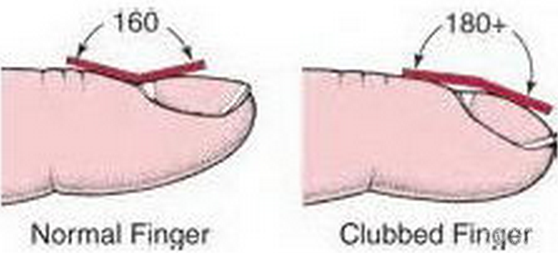 很吓人,看下图 再比较一下正常的手指(左)和杵状指(右)