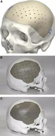 颅骨修补植入物的现状