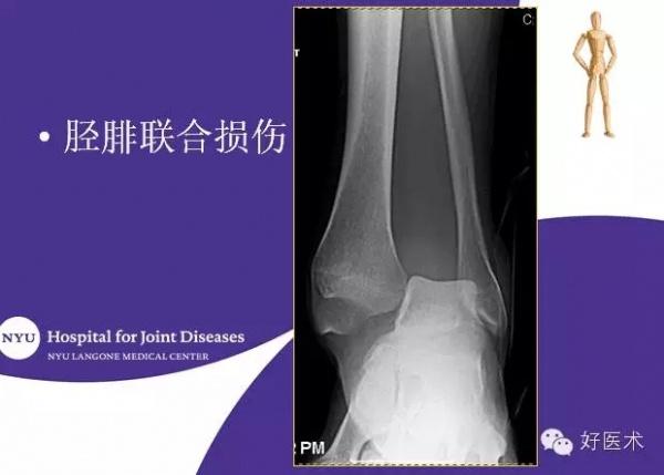 国际上踝关节骨折治疗的案例分析 - 骨科与显微