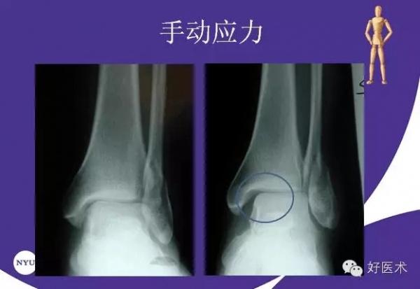 国际上踝关节骨折治疗的案例分析 - 骨科与显微
