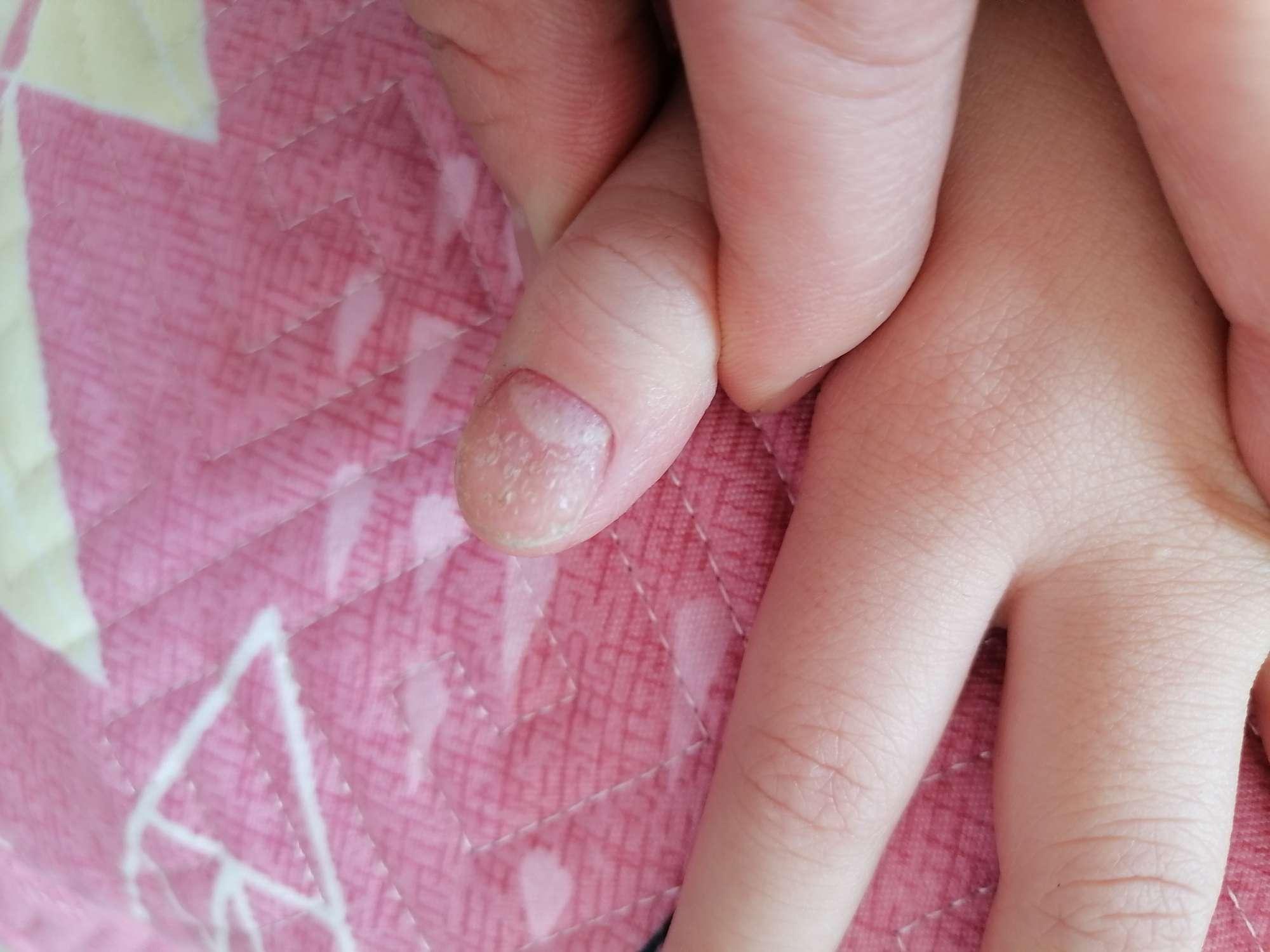 手指头慢性湿疹指甲出现白色斑点