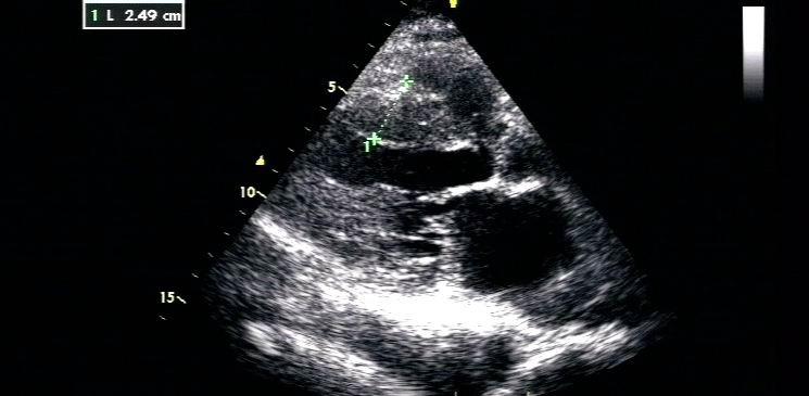 心脏超声图片
