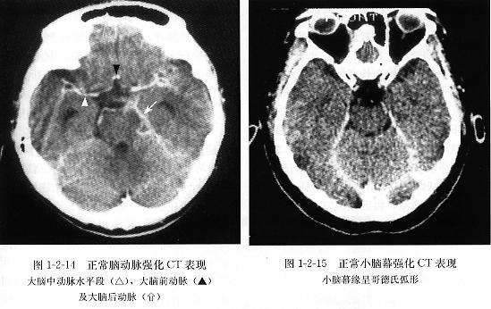 正常头颅ct,mri图解