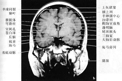 正常头颅ct,mri图解