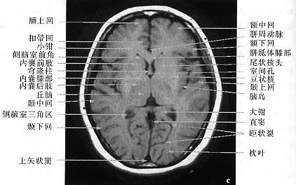 正常头颅ct,mri图解