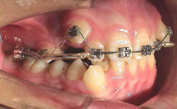 几张正畸图片 - 口腔医学专业讨论版 - 爱爱医医学论坛