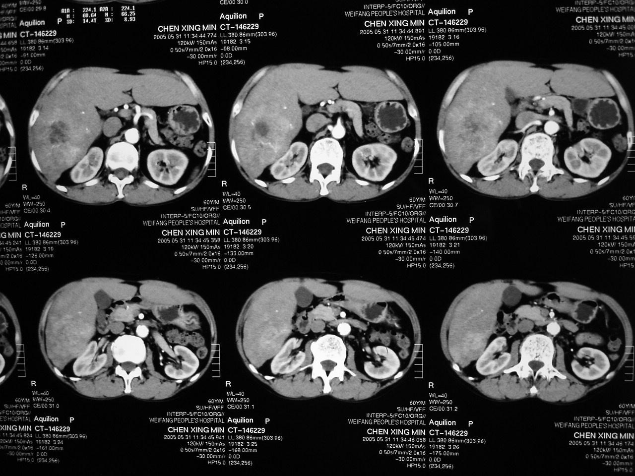 【原创】肝癌ct,dsa图象,介入治疗