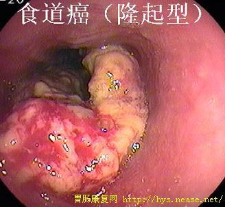 胃的血管和胃镜图片