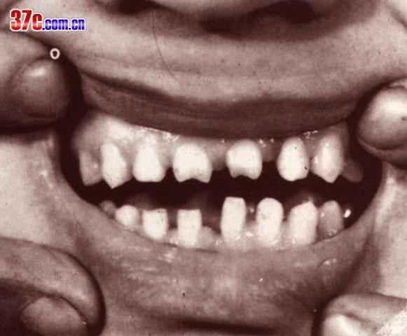 20050421085059932梅毒性角膜基质炎(hutchinson氏牙齿).jpg