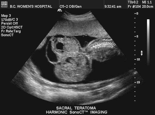 【推荐】个人收藏胎儿各种畸型b超图