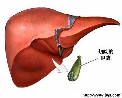 胆囊切除术