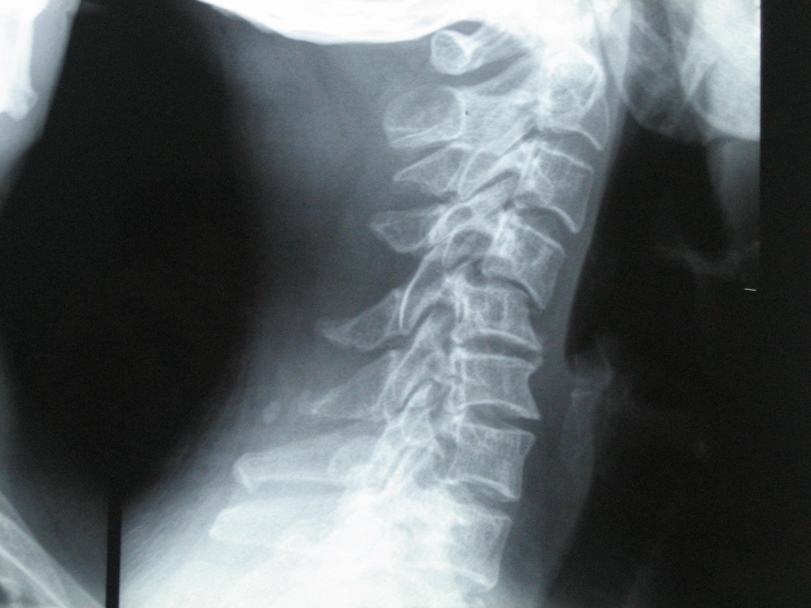 69【讨论】颈椎骨折手术治疗 在我院行颅骨牵引7天后的x片