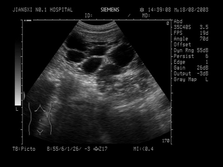 转贴:多囊肾1张 超声医学讨论版 爱爱医医学论坛