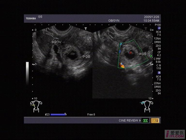 【贴图】宫外孕 超声医学讨论版 爱爱医医学论坛