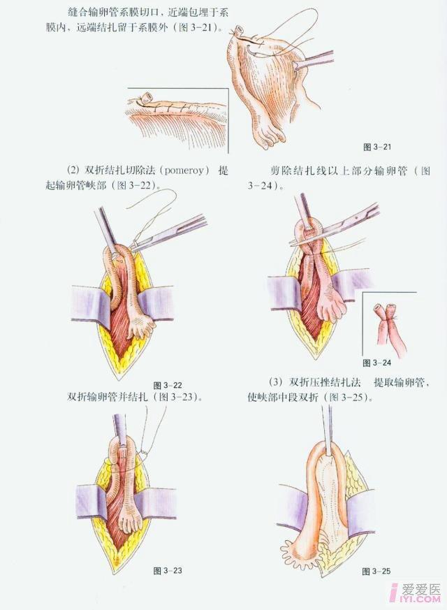 经腹部输卵管绝育手术操作图片