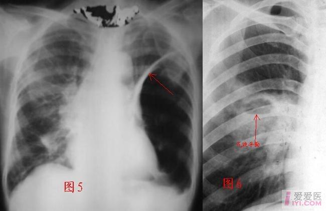 一组空洞空腔性病变