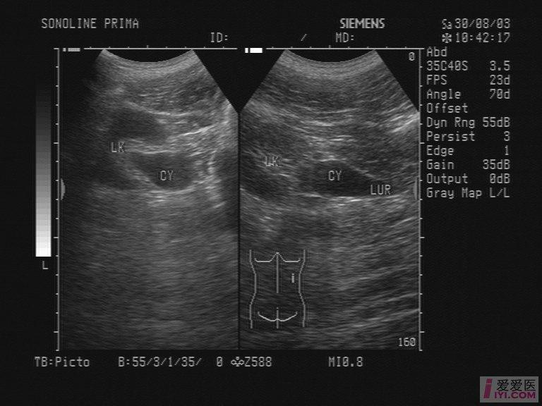 【贴图】肾外肾盂 - 超声医学讨论版 - 爱爱医医学论坛