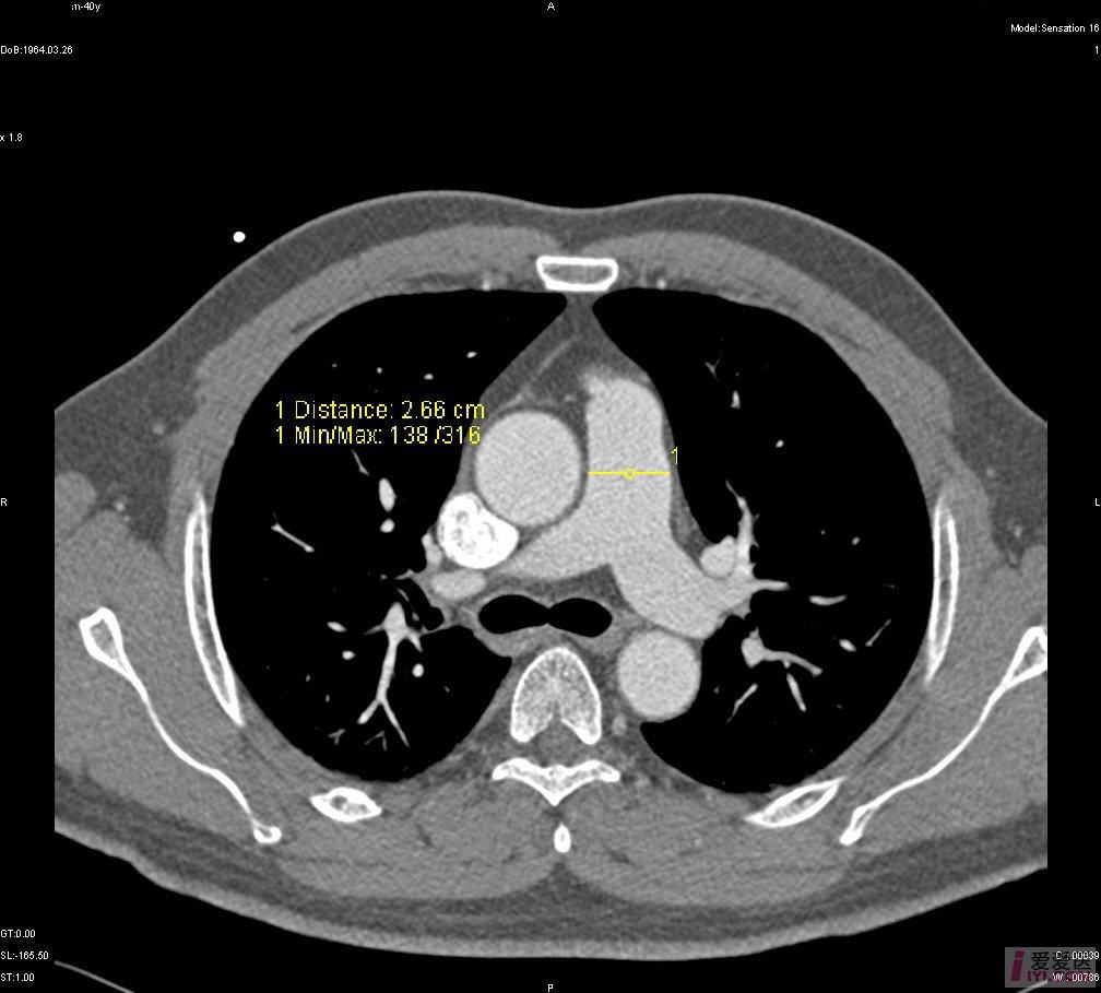 【资源】16层螺旋ct正常肺动脉管径的测量