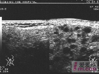 【分享】小日本的急性化脓性腮腺炎 - 超声医学讨论版