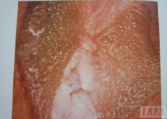 男性 .  尖锐湿疣诊断主要依据接触传染病史,尖锐湿疣发病部位